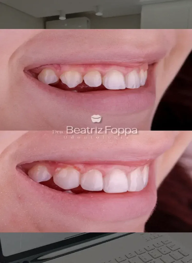 Antes e depois de tratamento de dentística no sorriso de uma paciente