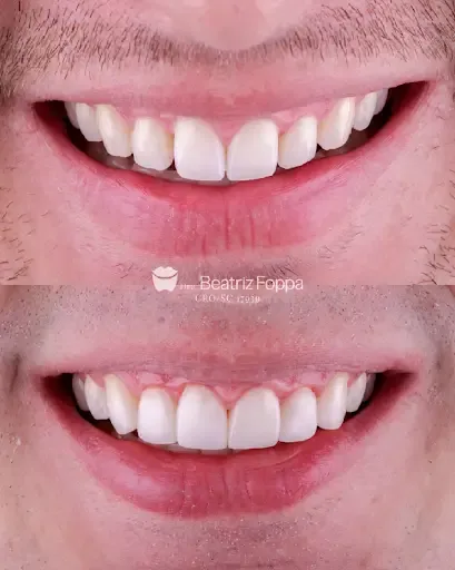 Antes e depois de tratamento de dentística no sorriso de um paciente