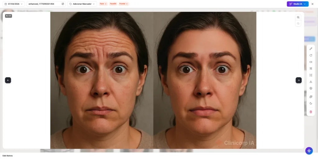 Imagem do Face Design Studio do Clinicorp, exibindo simulação de resultado de preenchimento facial antes e depois com base em foto real da paciente, recurso para gestão de procedimentos estéticos de preenchedores faciais.