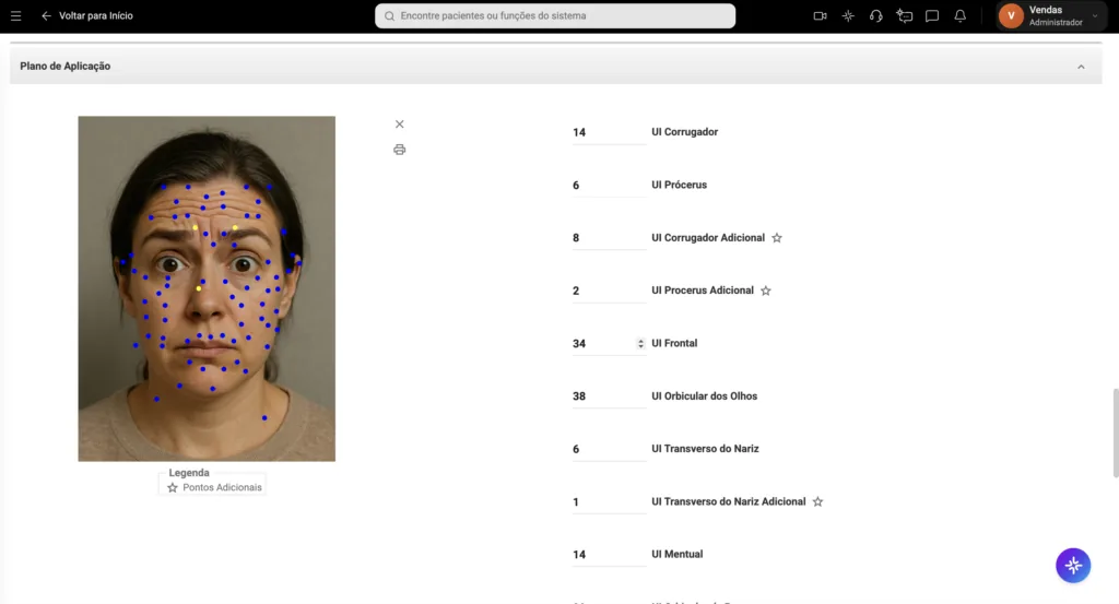 Imagem do plano de aplicação da Ficha de Especialidades do Clinicorp, exibindo mapeamento de pontos de toxina botulínica diretamente na foto da paciente com dosagens por região facial, recurso para gestão de procedimentos estéticos de preenchedores faciais.