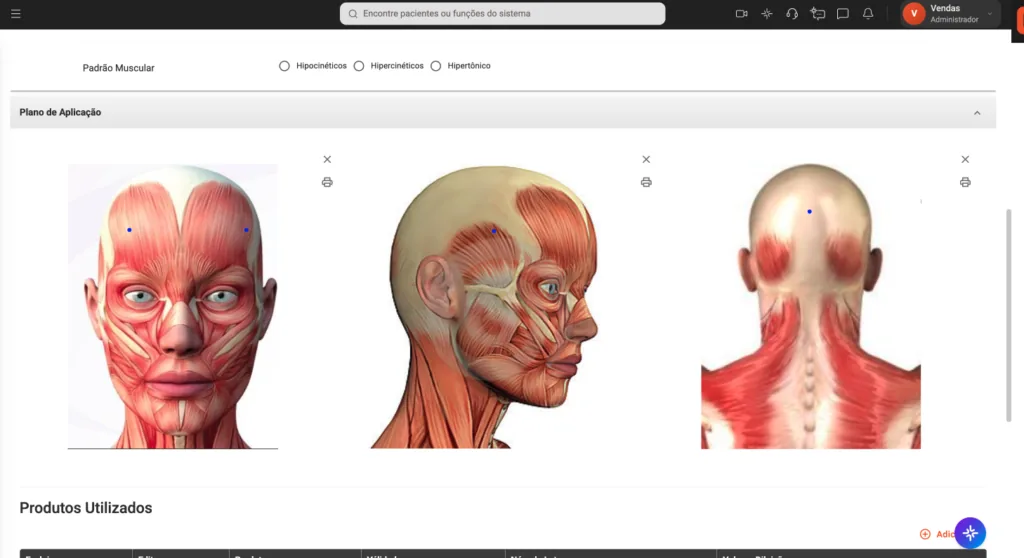 Imagem do plano de aplicação da ficha de Toxina Botulínica Terapêutica do software odontológico Clinicorp, exibindo mapeamento muscular facial em três ângulos — frontal, perfil e posterior — para planejamento de tratamentos de harmonização orofacial.