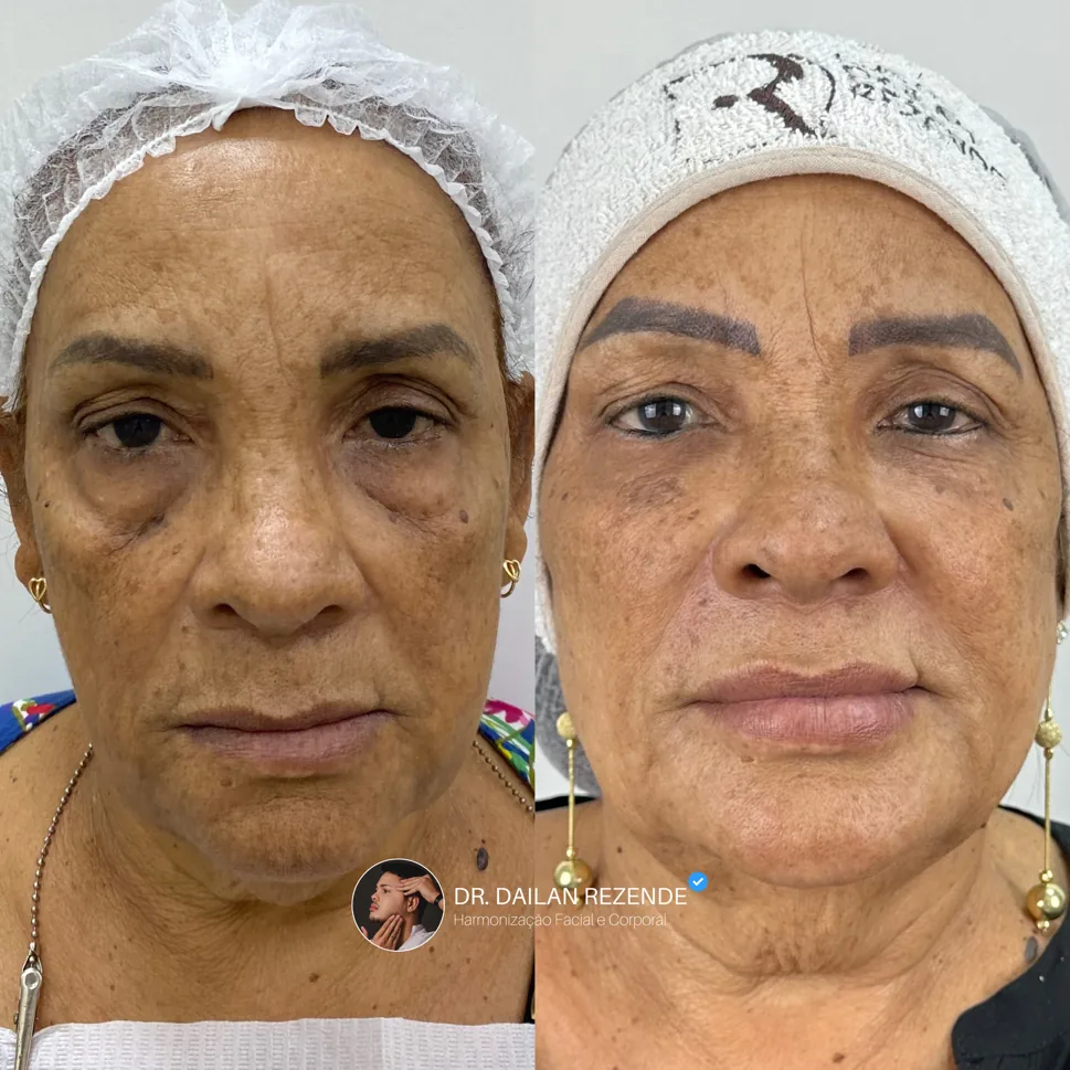Antes e depois de harmonização facial no rosto de uma paciente