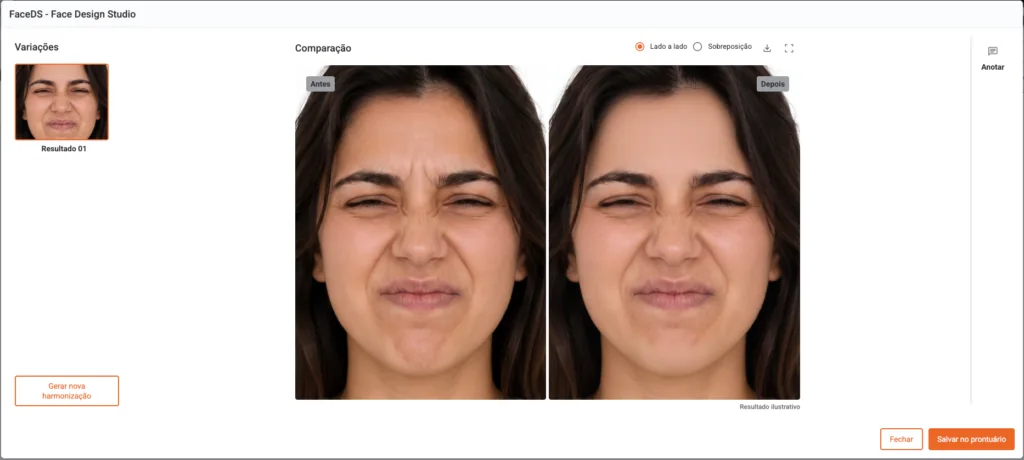 Aumentar conversão: imagem de simulação de antes x depois da aplicação de toxina butolinica em uma paciente. Utilizando o recurso Face Design Studio integrado ao Clinicorp IA.