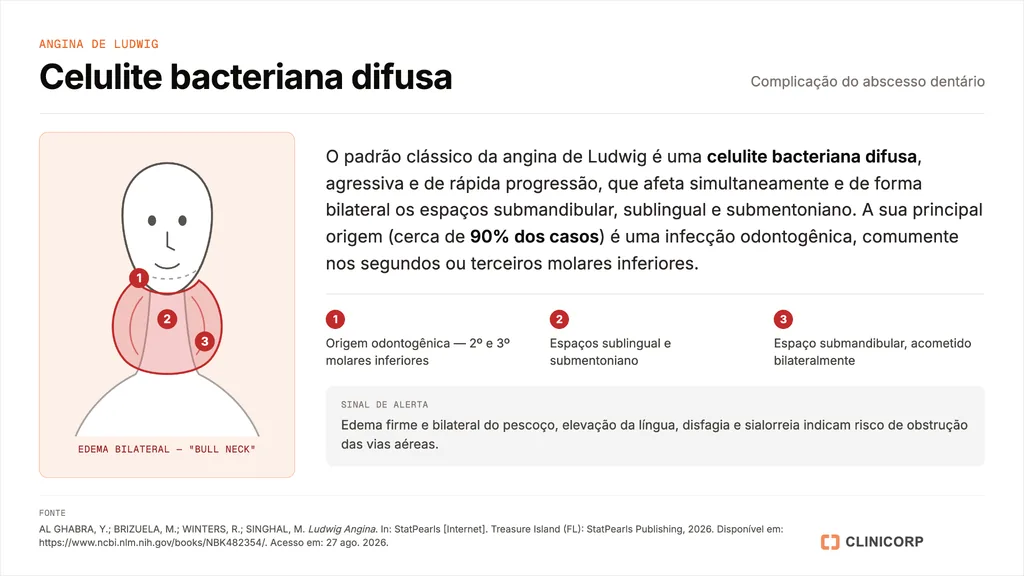 Infográfico sobre a angina de Ludwig, celulite bacteriana difusa que complica o abscesso dentário